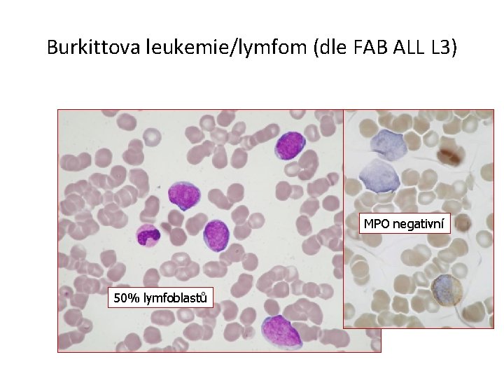 Burkittova leukemie/lymfom (dle FAB ALL L 3) MPO negativní 50% lymfoblastů 