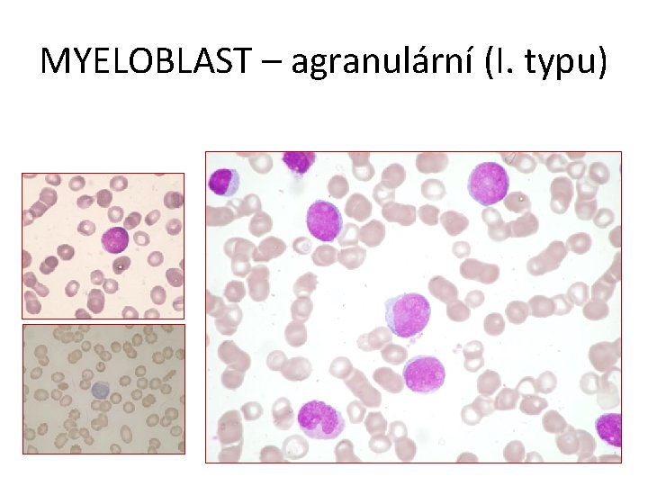 MYELOBLAST – agranulární (I. typu) 