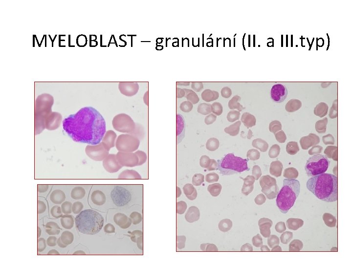 MYELOBLAST – granulární (II. a III. typ) 