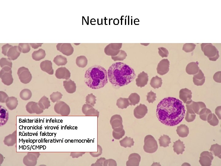 Neutrofílie Bakteriální infekce Chronické virové infekce Růstové faktory Myeloproliferativní onemocnění MDS/CMPD 