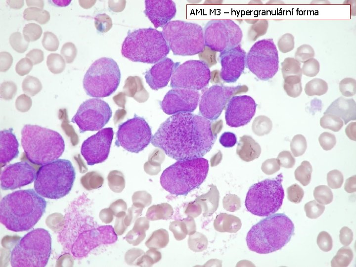 AML M 3 – hypergranulární forma 