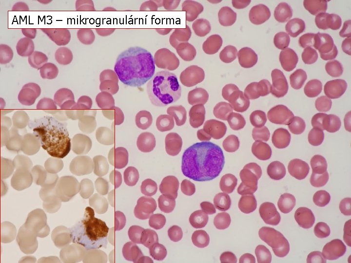 AML M 3 – mikrogranulární forma 