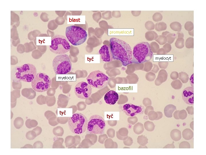 blast promyelocyt tyč myelocyt bazofil tyč 