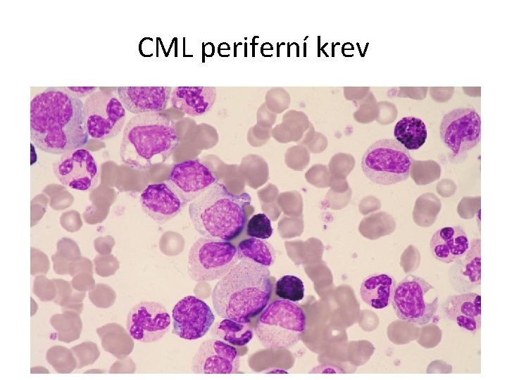 CML periferní krev 