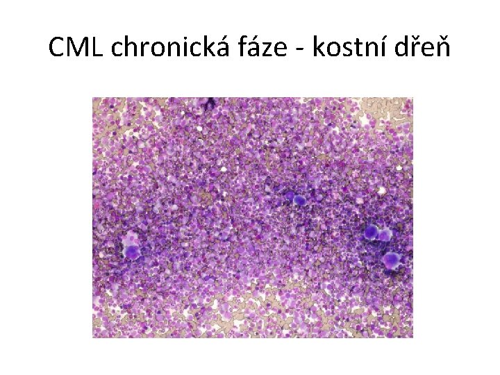 CML chronická fáze - kostní dřeň 