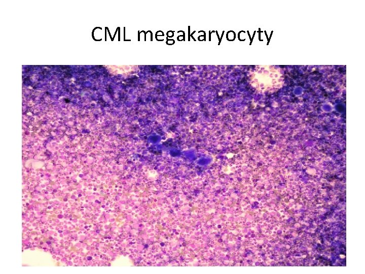 CML megakaryocyty 