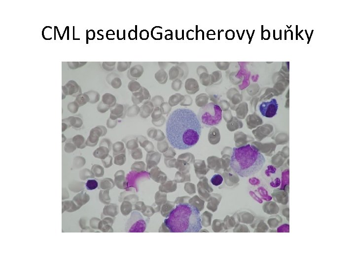 CML pseudo. Gaucherovy buňky 