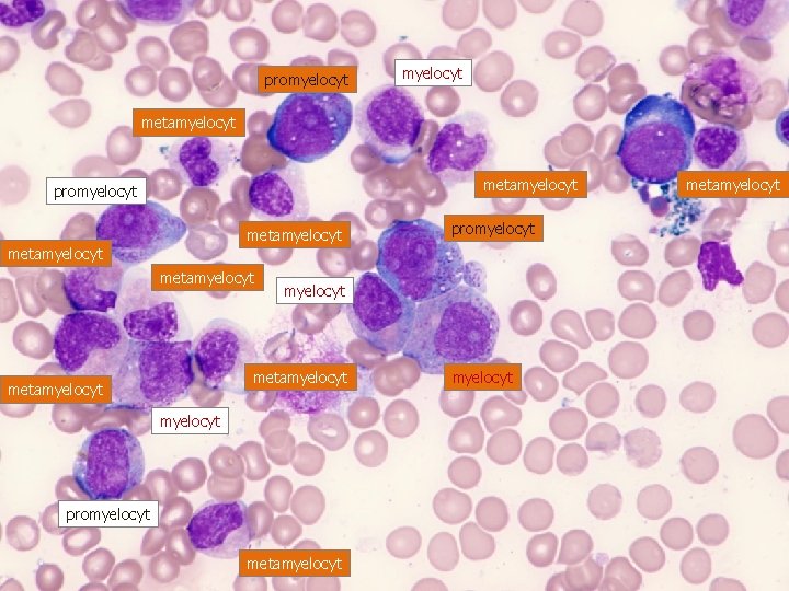 promyelocyt metamyelocyt metamyelocyt myelocyt promyelocyt metamyelocyt 