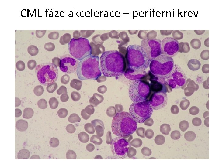 CML fáze akcelerace – periferní krev 