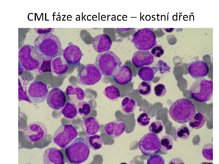 CML fáze akcelerace – kostní dřeň 