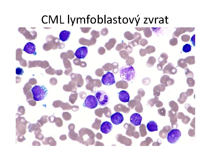 CML lymfoblastový zvrat 