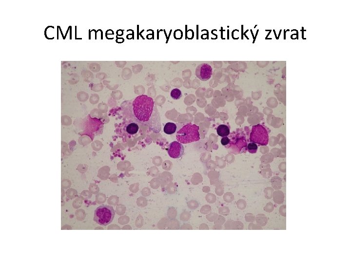 CML megakaryoblastický zvrat 