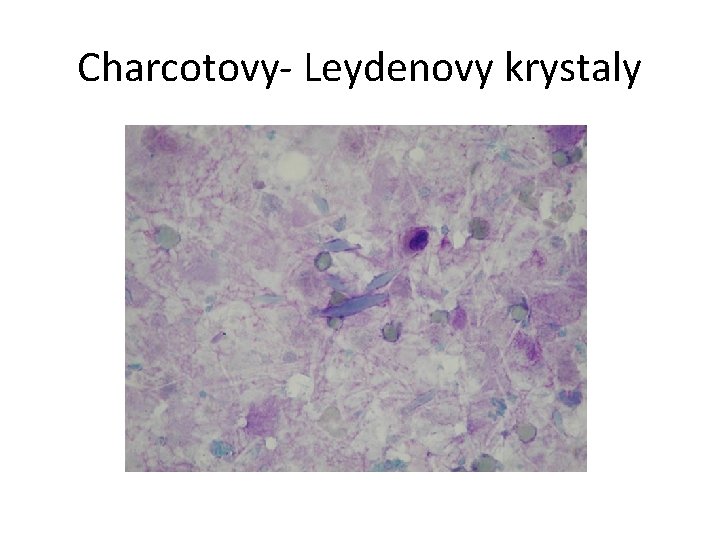 Charcotovy- Leydenovy krystaly 