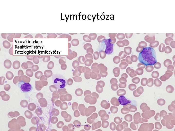 Lymfocytóza Virové infekce Reaktivní stavy Patologické lymfocytózy 