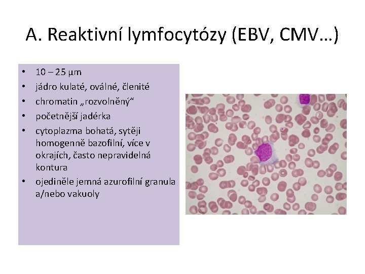 A. Reaktivní lymfocytózy (EBV, CMV…) 10 – 25 µm jádro kulaté, oválné, členité chromatin