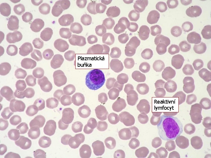 Plazmatická buňka Reaktivní lymfocyt 