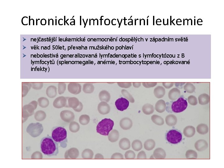 Chronická lymfocytární leukemie Ø nejčastější leukemické onemocnění dospělých v západním světě Ø věk nad