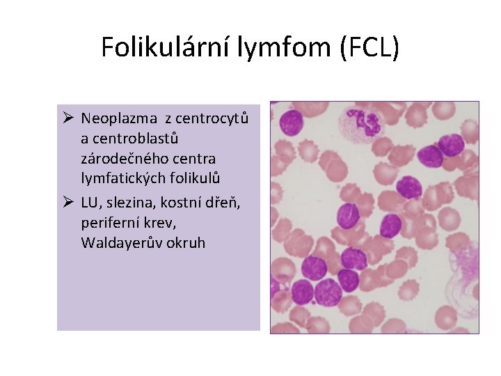 Folikulární lymfom (FCL) Ø Neoplazma z centrocytů a centroblastů zárodečného centra lymfatických folikulů Ø