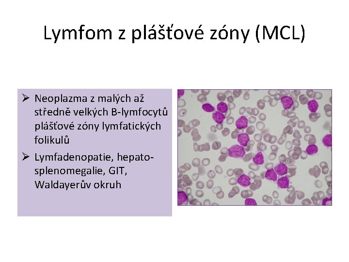 Lymfom z plášťové zóny (MCL) Ø Neoplazma z malých až středně velkých B-lymfocytů plášťové