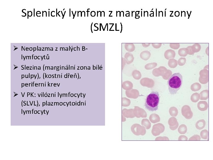 Splenický lymfom z marginální zony (SMZL) Ø Neoplazma z malých Blymfocytů Ø Slezina (marginální