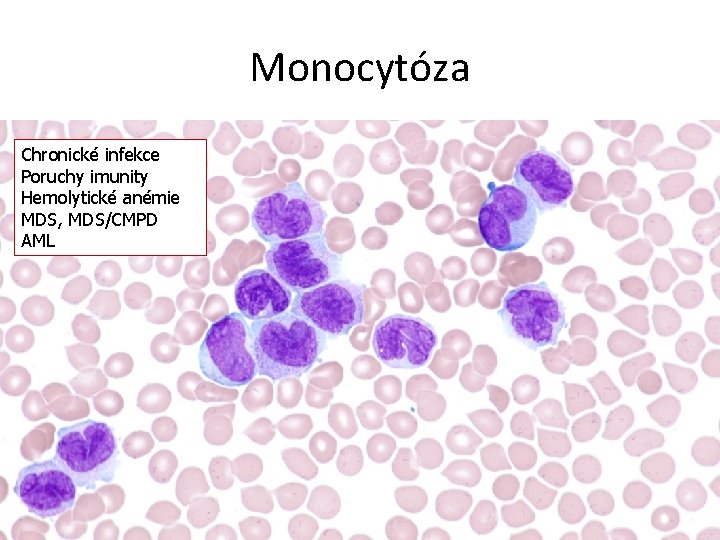 Monocytóza Chronické infekce Poruchy imunity Hemolytické anémie MDS, MDS/CMPD AML 