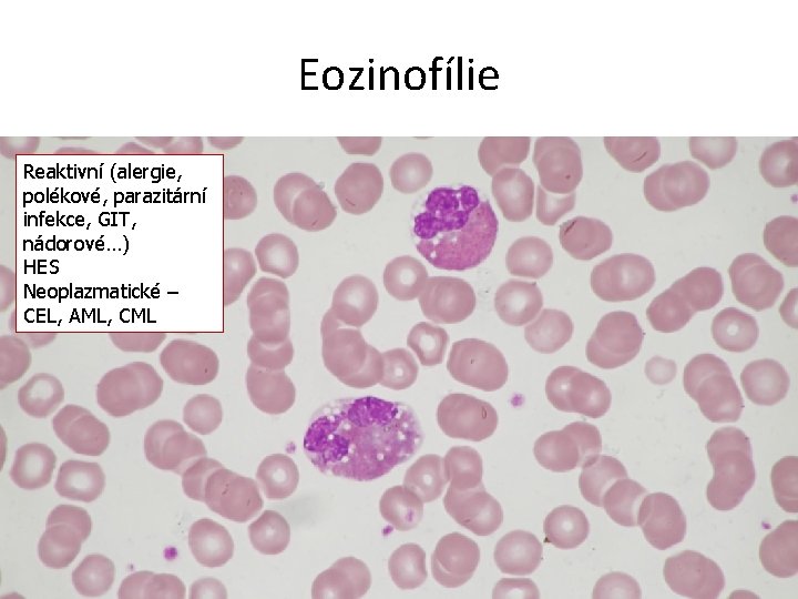 Eozinofílie Reaktivní (alergie, polékové, parazitární infekce, GIT, nádorové…) HES Neoplazmatické – CEL, AML, CML