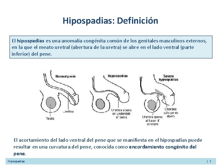 Hipospadias: Definición El hipospadias es una anomalía congénita común de los genitales masculinos externos,
