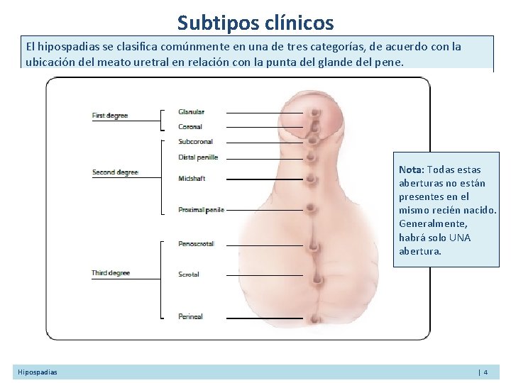 Subtipos clínicos El hipospadias se clasifica comúnmente en una de tres categorías, de acuerdo