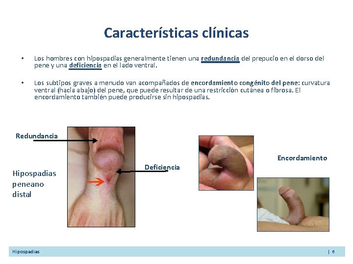 Características clínicas • Los hombres con hipospadias generalmente tienen una redundancia del prepucio en