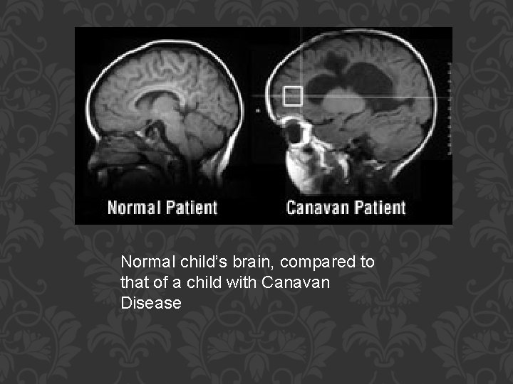 Normal child’s brain, compared to that of a child with Canavan Disease 