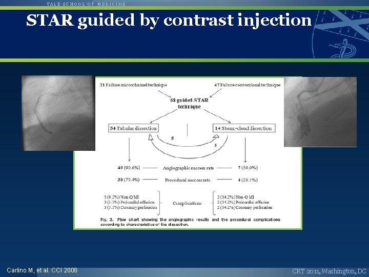 YALE SCHOOL OF MEDICINE STAR guided by contrast injection Carlino M, et al. CCI