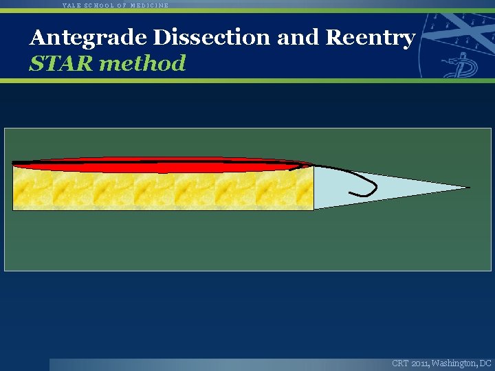 YALE SCHOOL OF MEDICINE Antegrade Dissection and Reentry STAR method CRT 2011, Washington, DC