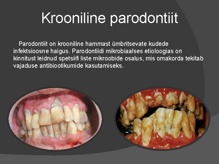 Krooniline parodontiit Parodontiit on krooniline hammast ümbritsevate kudede infektsioosne haigus. Parodontiidi mikrobiaalses etioloogias on