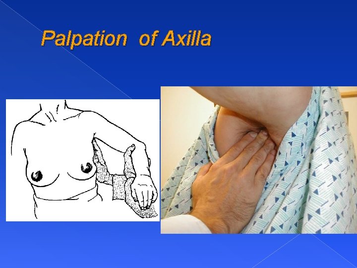 Palpation of Axilla 