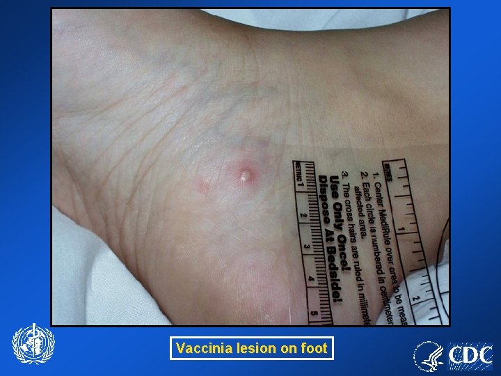 Vaccinia lesion on foot 