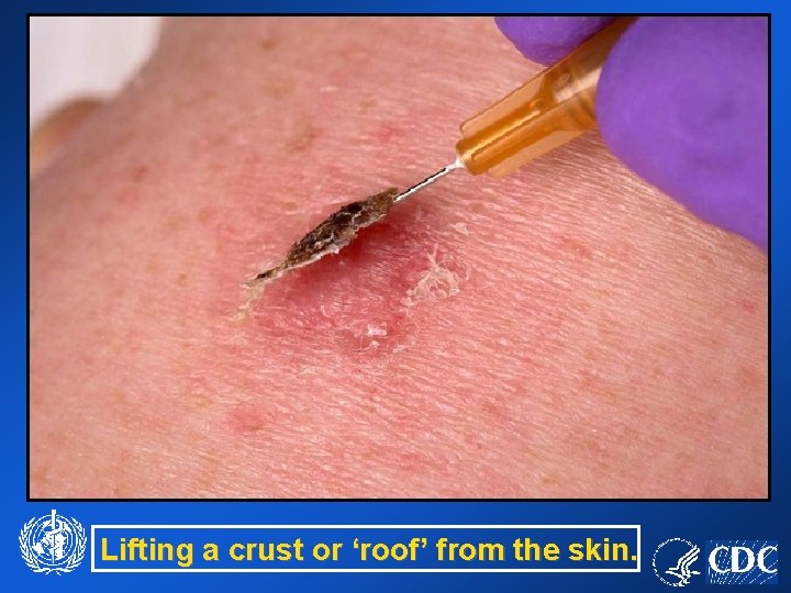 Lifting a crust or ‘roof’ from the skin. 