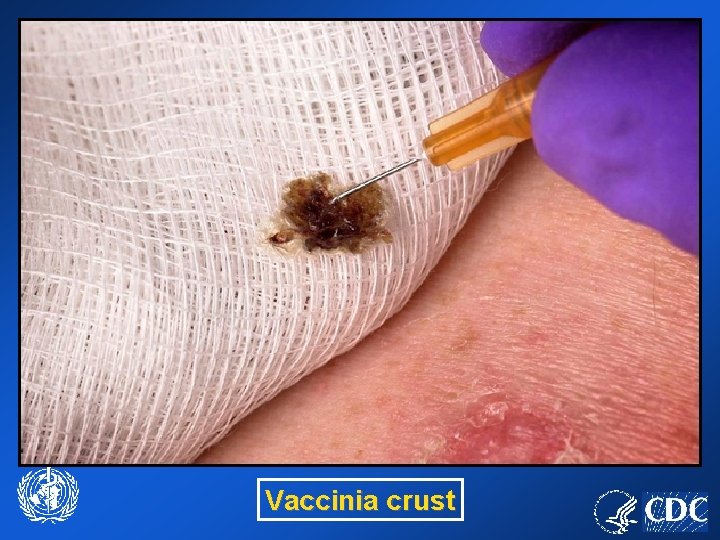 Vaccinia crust 