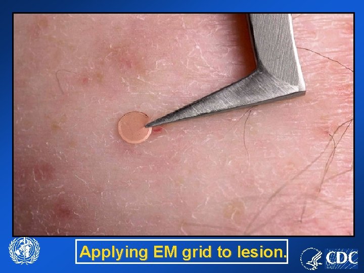 Applying EM grid to lesion. 