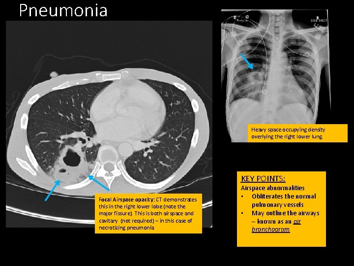 Pneumonia Heavy space occupying density overlying the right lower lung. KEY POINTS: Focal Airspace