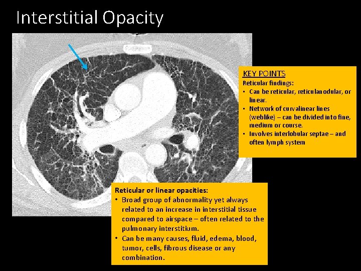 Interstitial Opacity KEY POINTS Reticular findings: • Can be reticular, reticulanodular, or linear. •