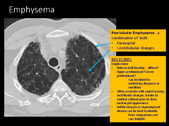 Emphysema Pan-lobular Emphysema: a combination of both • Paraseptal • Centrilobular changes KEY POINTS