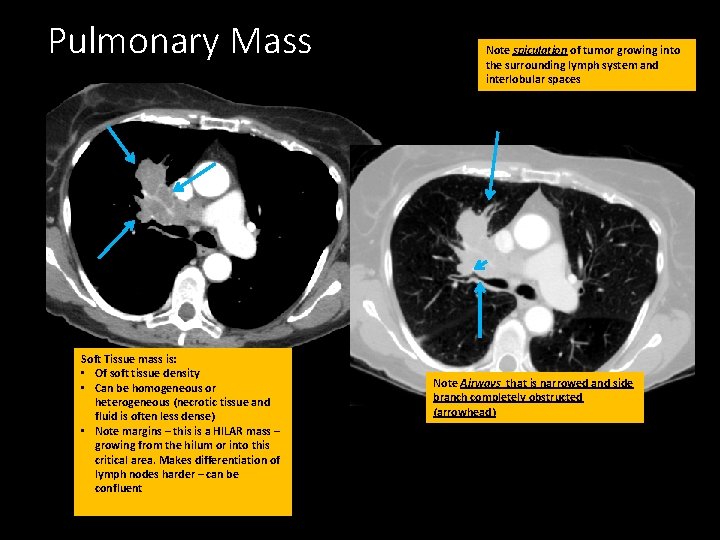 Pulmonary Mass Soft Tissue mass is: • Of soft tissue density • Can be