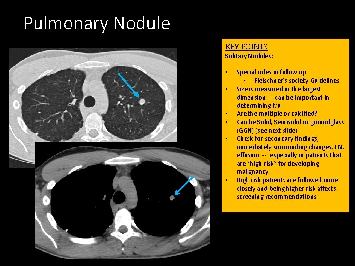 Pulmonary Nodule KEY POINTS Solitary Nodules: • • • Special rules in follow up