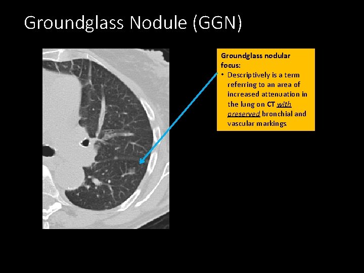 Groundglass Nodule (GGN) Groundglass nodular focus: • Descriptively is a term referring to an