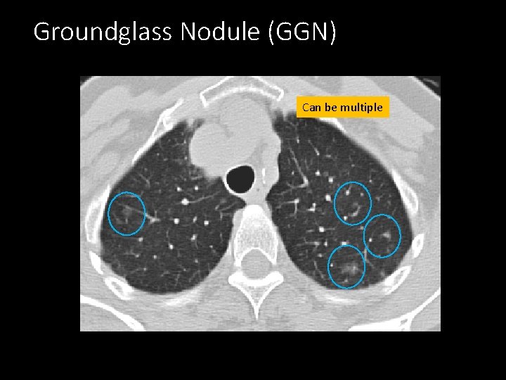 Groundglass Nodule (GGN) Can be multiple 