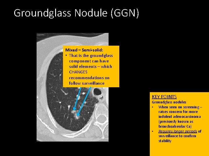 Groundglass Nodule (GGN) Mixed – Semi-solid: • That is the groundglass component can have