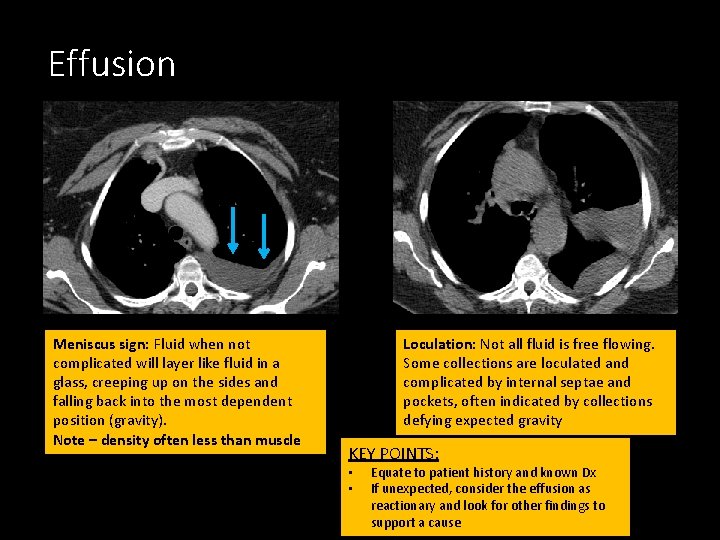 Effusion Meniscus sign: Fluid when not complicated will layer like fluid in a glass,