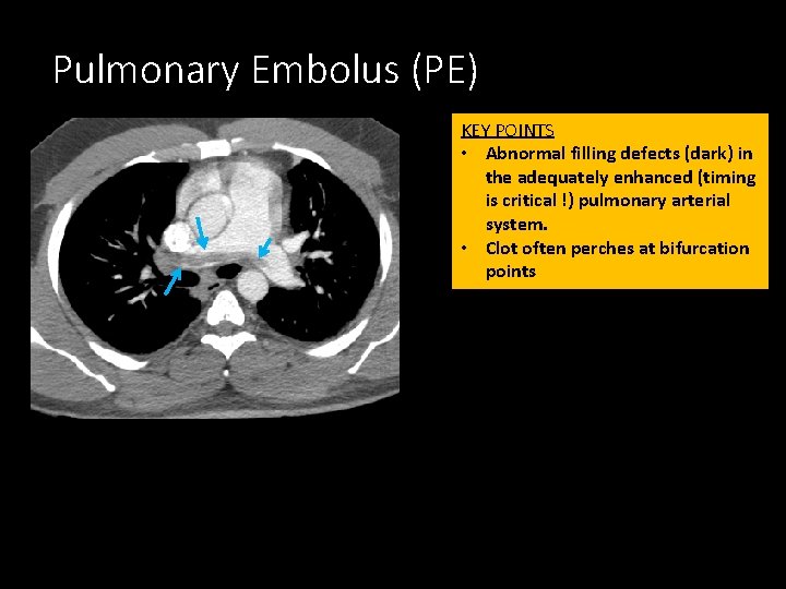 Pulmonary Embolus (PE) KEY POINTS • Abnormal filling defects (dark) in the adequately enhanced