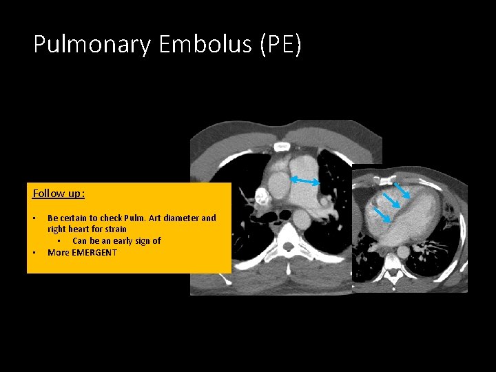 Pulmonary Embolus (PE) Follow up: • • Be certain to check Pulm. Art diameter