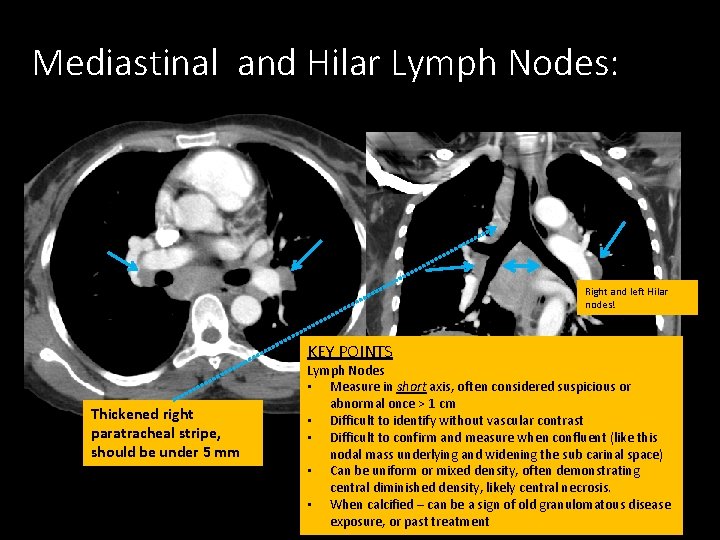 Mediastinal and Hilar Lymph Nodes: Right and left Hilar nodes! KEY POINTS Thickened right